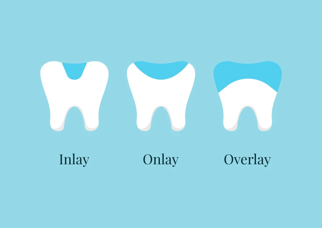 Dental inlay, onlay, and overlay illustration for patients in Arlington Heights, IL
